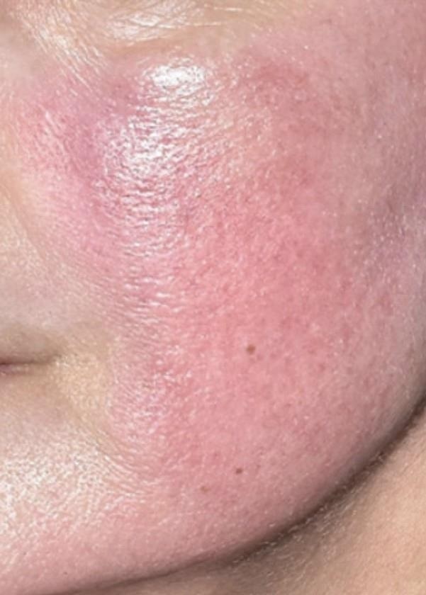 Rosacea Before (1)