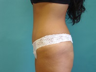 Dr. Serra Plastic Surgery Before & After