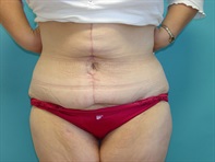 Dr. Serra Plastic Surgery Before & After